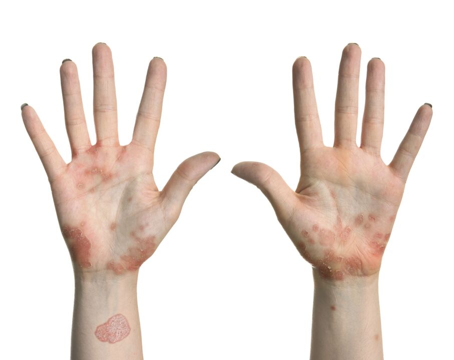 Psoriasis an den Händen